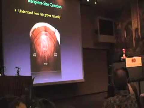 Modern Hair Transplant Techniques, Cedars-Sinai