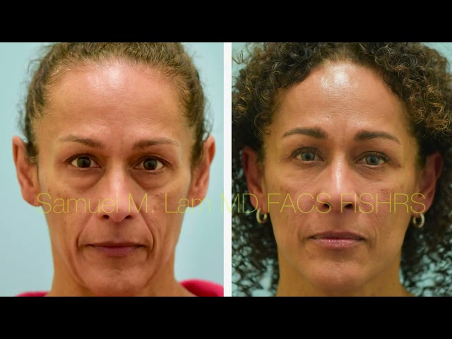 9 Months Fat Grafting, Blepharoplasty, and Deep-Neck + Deep-Plane Facelift Testimonial in Dallas