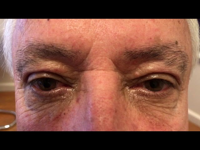 One Week After Male Upper Blepharoplasty (Photos Included)