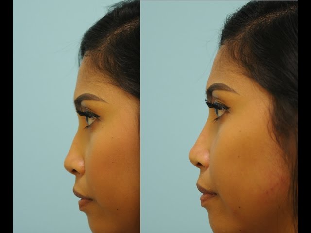 Injectable Rhinoplasty with Cannula by Dr. Sam Lam