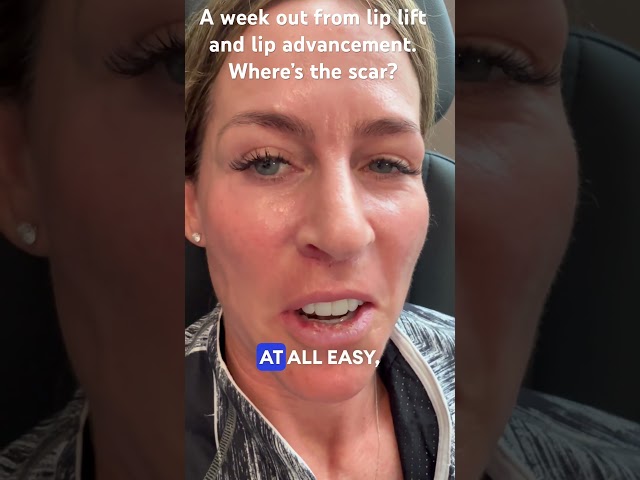 A week out from lip lift and lip advancement.  Where’s the scar?