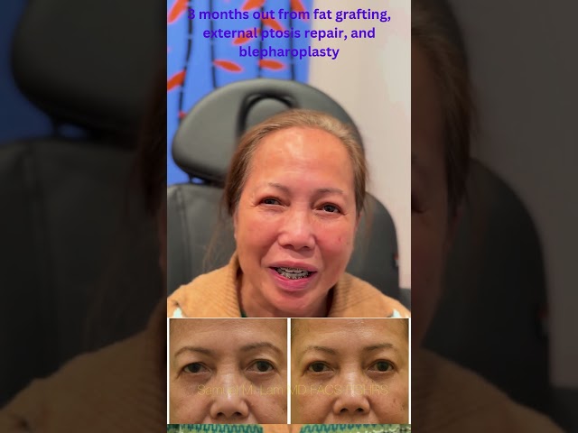 Dallas Ptosis, Upper Blepharoplasty, Fat Grafting Testimonial with Photos