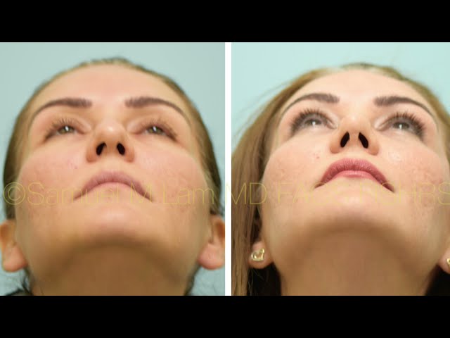 Dallas Rhinoplasty, Fat Transfer, Lower Blepharoplasty, and Lip Microfat Before and After