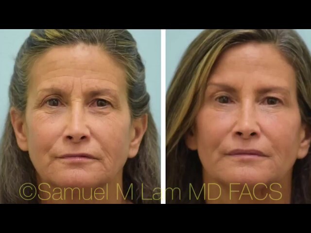 First-Time Botox/Fillers Testimonial w/Photos