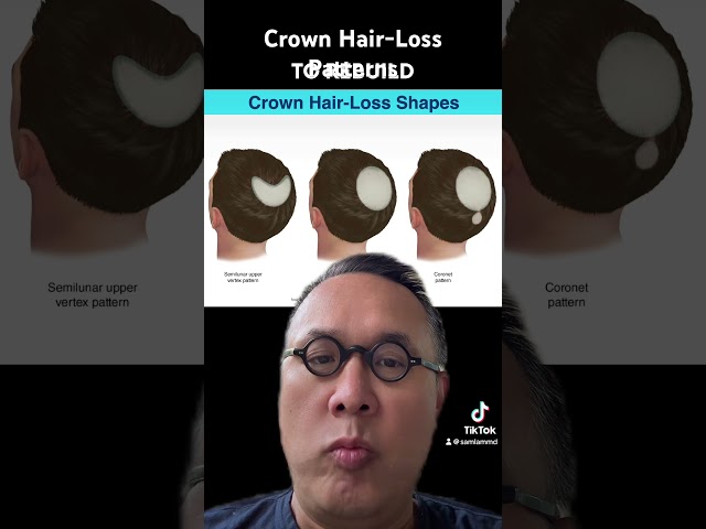 Crown Hair-Loss Patterns