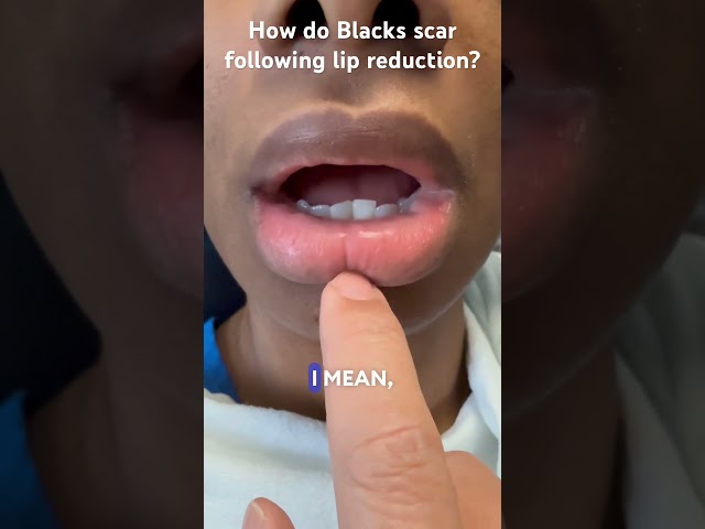 How do Blacks scar following lip reduction?