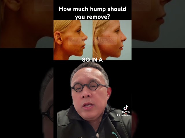 How much hump should you remove?