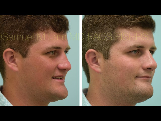 Dallas Rhinoplasty Before and After One Week Out