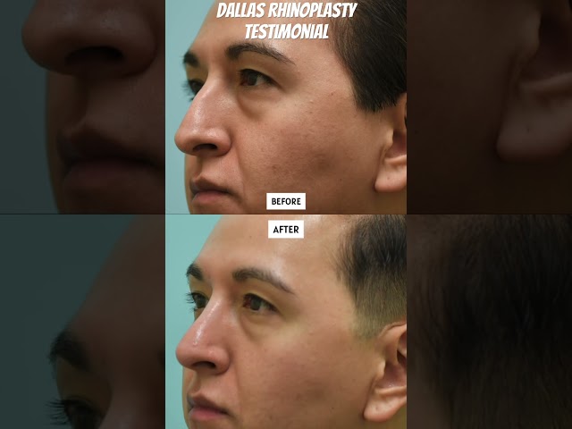 Dallas Rhinoplasty Testimonial with Before and After Reaults