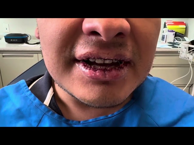 Revision Lip Reduction Surgery Testimonial Immediately After