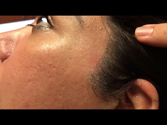 Facelift/Sideburn Hair Transplant Scar Correction HD Close-Up Result