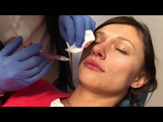 Volbella Injection