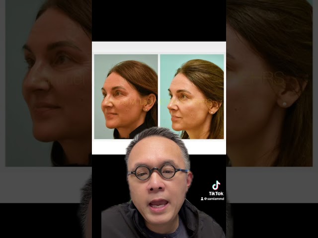 Rejuvenative Rhinoplasty?  What does that mean?