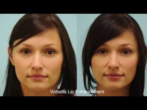 Volbella Follow Up Results and Commentary in Dallas