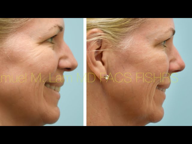 Traumatic Rhinoplasty Testimonial for Breathing and Cosmetics in Dallas, Texas