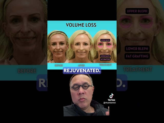 Part 2 of Facial Rejuvenation Series: Volume Loss