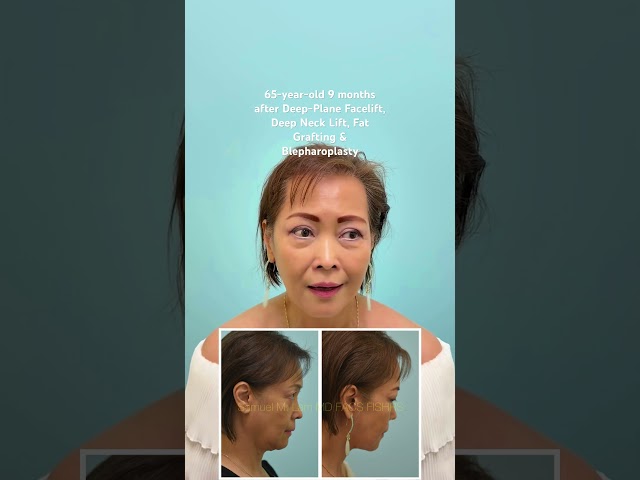 65-year-old 9 months after Deep-Plane Facelift, Deep Neck Lift, Fat Grafting & Blepharoplasty