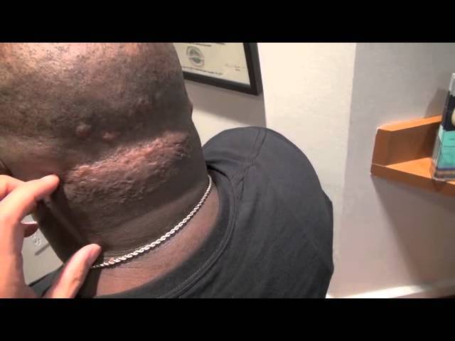 Head/Scalp Keloid Correction for African-American Patient in Dallas, Texas