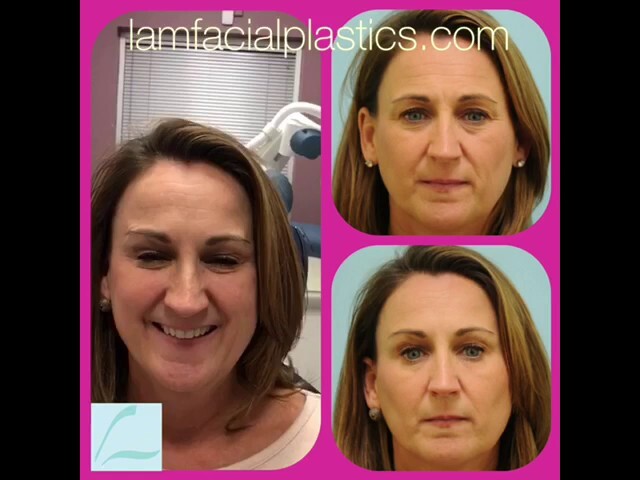 First-Time Fillers & Botox Testimonial in Dallas, TX