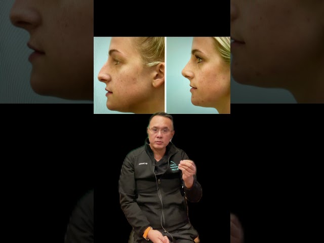 Is this just a rhinoplasty with a hump reduction?  No! Listen to Dr. Lam’s short explanation.