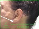DALLAS FACE LIFT INCISION CLEANING TUTORIAL