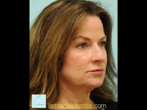 Fat Grafting Videos