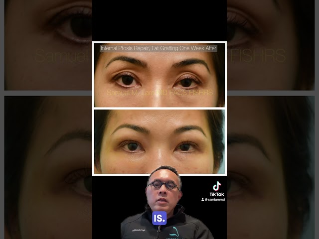 Browlift? No Blepharoplasty? No