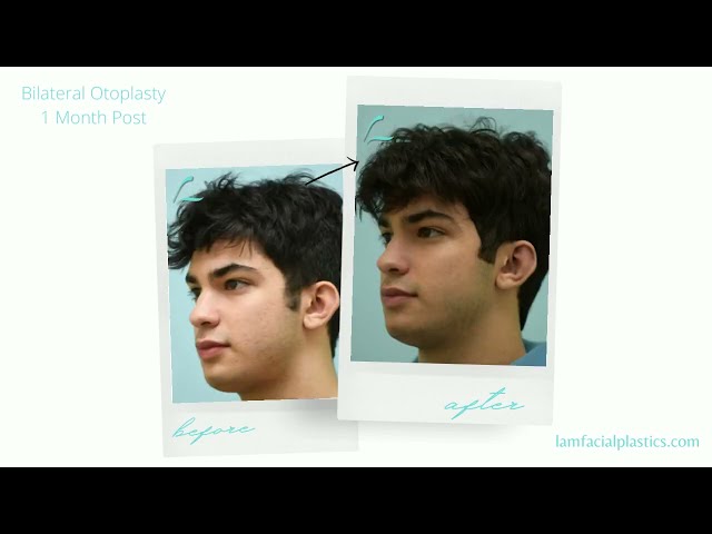Dallas Cosmetic Surgery | Patient Testimonial | Bilateral Otoplasty