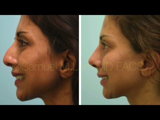 Indian Rhinoplasty Testimonial & Photos by Dr. Lam in Dallas, Texas