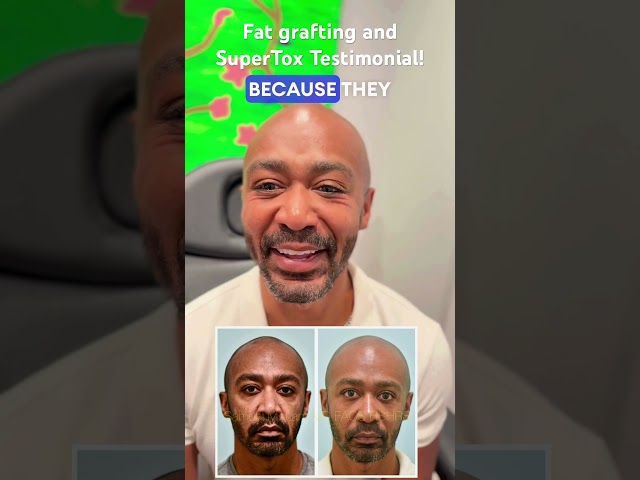 Fat Grafting and SuperTox Testimonial!