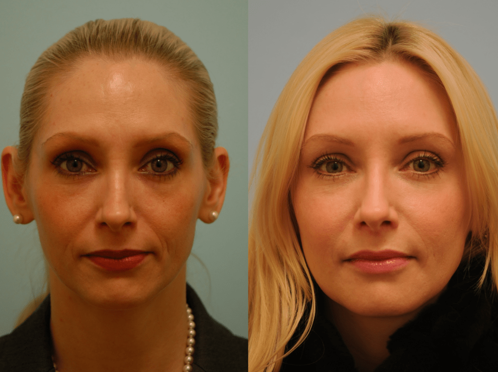 Facial Fillers in Dallas