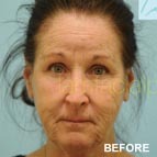 Image of a Laser Skin Surfacing patient