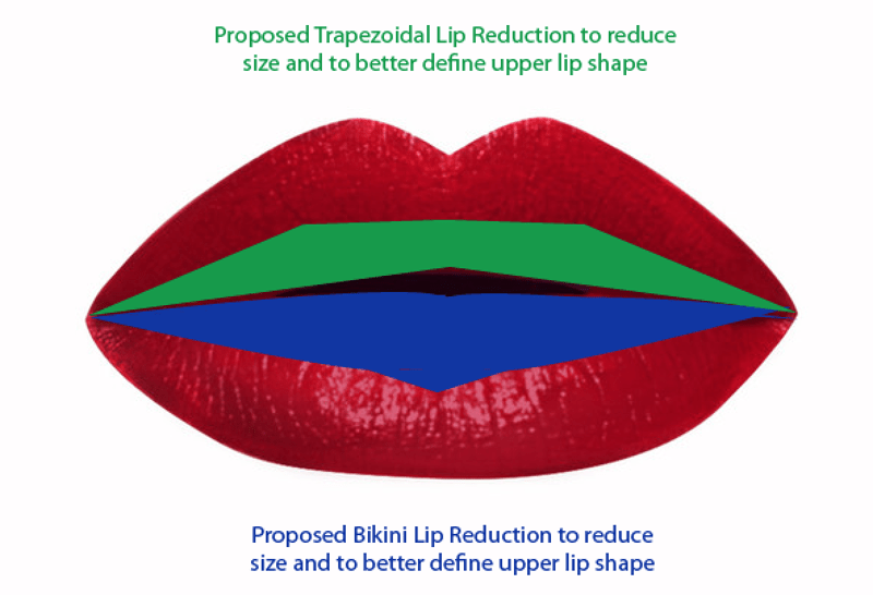 Lip Reduction