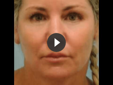 Laser Skin Resurfacing Videos