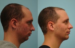 Chin Augmentation Before & After