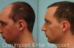 Chin Augmentation Before & After