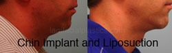Chin Augmentation Before & After