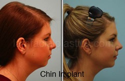 Chin Augmentation Before & After