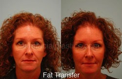 Fat Grafting Before & After