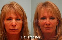 Fat Grafting Before & After