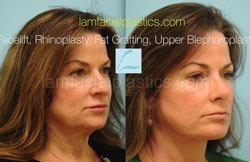 Fat Grafting Before & After