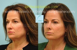 Fat Grafting Before & After