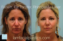 Fat Grafting Before & After