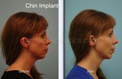 Fat Grafting Before & After