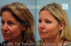 Fat Grafting Before & After