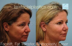 Fat Grafting Before & After