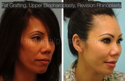 Fat Grafting Before & After