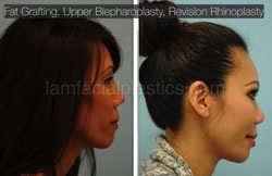 Fat Grafting Before & After