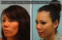 Fat Grafting Before & After