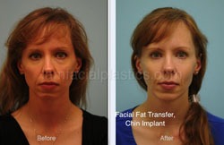 Fat Grafting Before & After